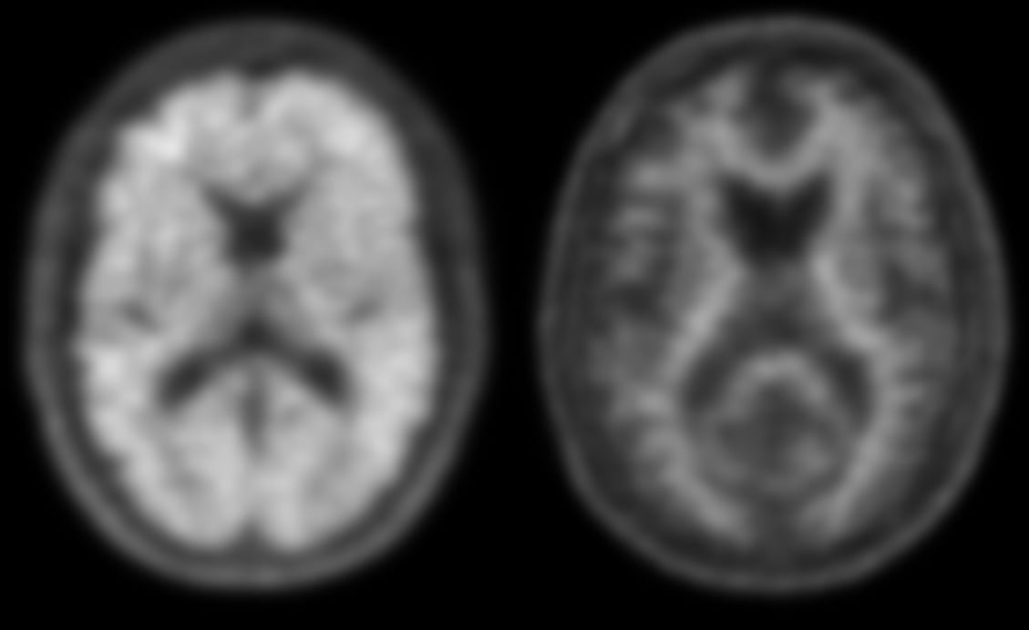 Landmark Trial: Amyloid PET Scans Improve Alzheimer's Diagnosis, Management